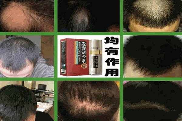 頂上世家止脫生發養發加盟